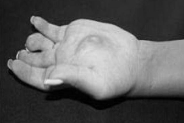 A hand with a desmoid tumor