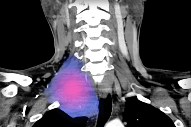 CT scan of desmoid tumor in the neck.