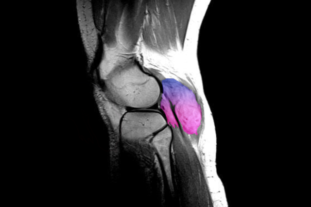 MRI image of a desmoid tumor behind the knee
